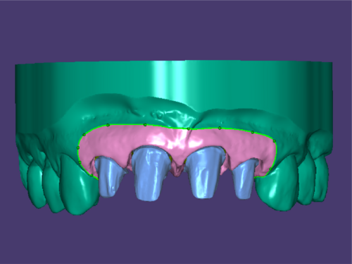 Plateless model design Mask 1 Galway.png